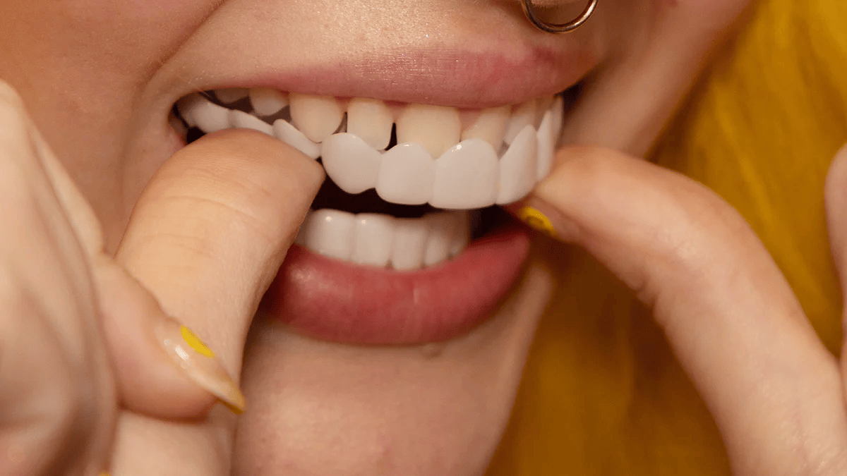 Snap-On Veneers für obere und untere Zähne für ein sofort natürliches Lächeln