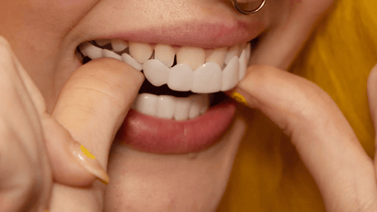 Snap-On Veneers für obere und untere Zähne für ein sofort natürliches Lächeln