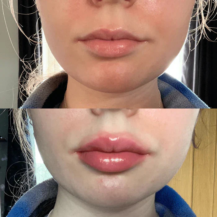 Schnelles Lippenfüllserum