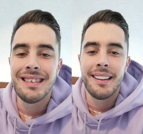 Snap-On Veneers für obere und untere Zähne für ein sofort natürliches Lächeln