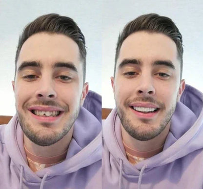 Snap-On Veneers für obere und untere Zähne für ein sofort natürliches Lächeln