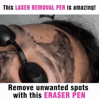 Laserpen zur Entfernung von Tattoos, Muttermalen und Sommersprossen