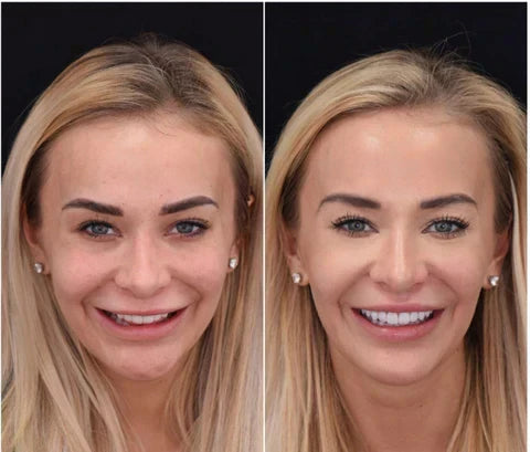 Snap-On Veneers für obere und untere Zähne für ein sofort natürliches Lächeln