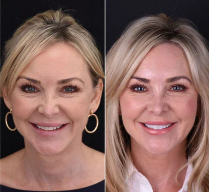 Snap-On Veneers für obere und untere Zähne für ein sofort natürliches Lächeln