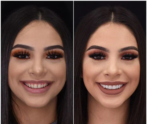 Snap-On Veneers für obere und untere Zähne für ein sofort natürliches Lächeln