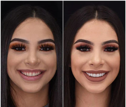 Snap-On Veneers für obere und untere Zähne für ein sofort natürliches Lächeln